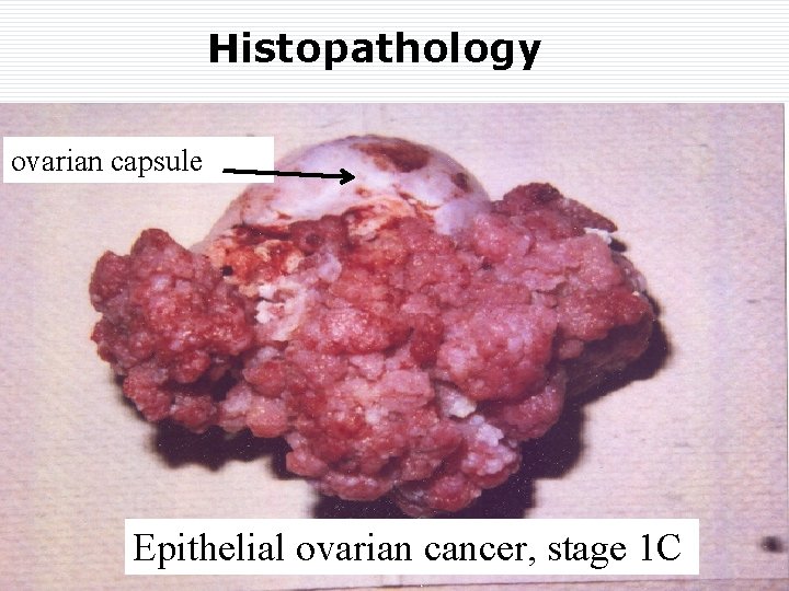 Histopathology ovarian capsule Epithelial ovarian cancer, stage 1 C 