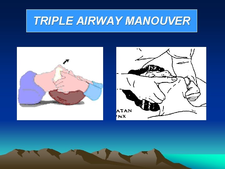 TRIPLE AIRWAY MANOUVER 