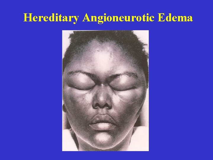 Hereditary Angioneurotic Edema 