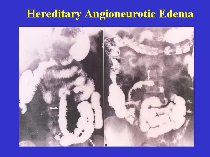 Hereditary Angioneurotic Edema 