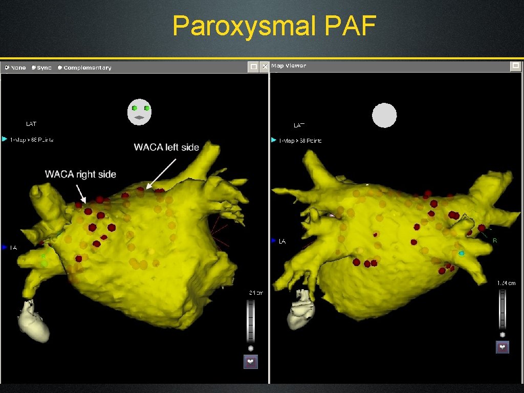 Paroxysmal PAF 