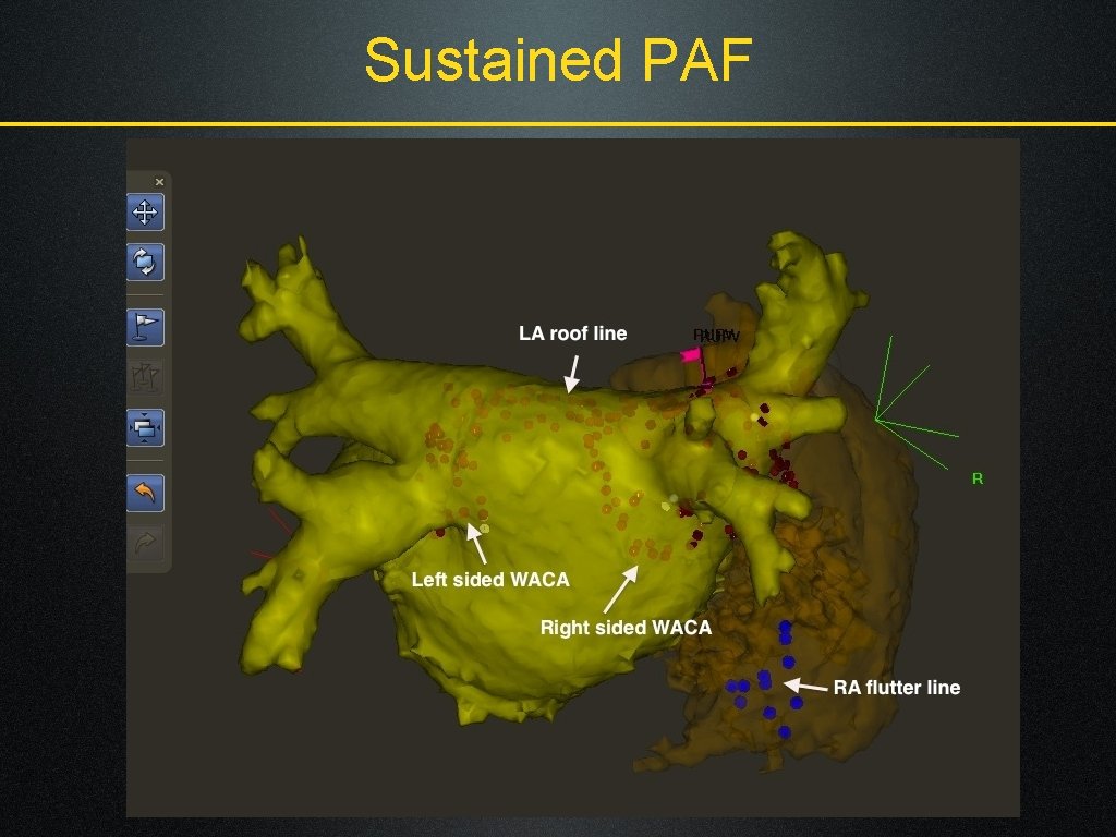 Sustained PAF 