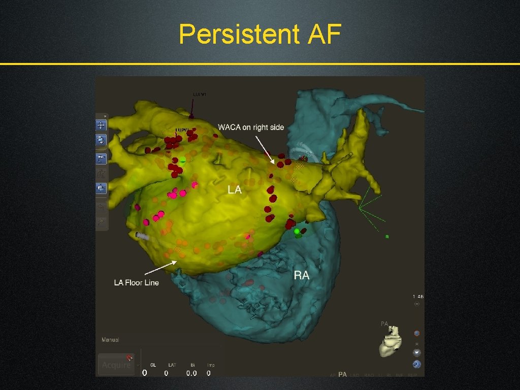 Persistent AF 