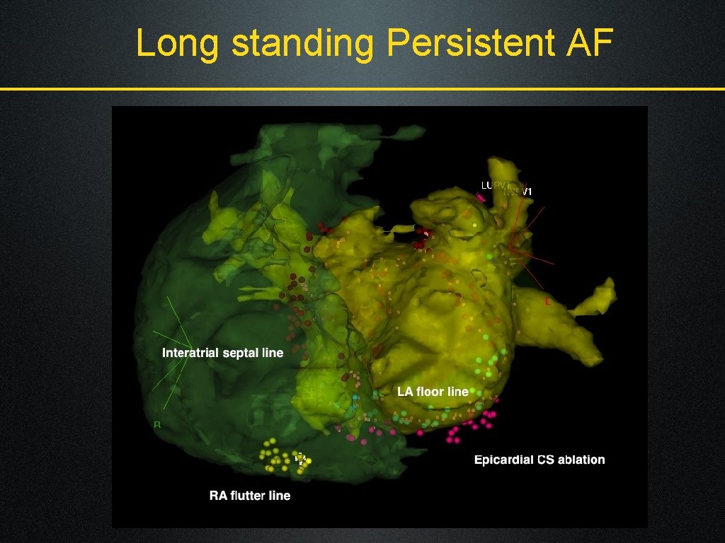 Long standing Persistent AF 