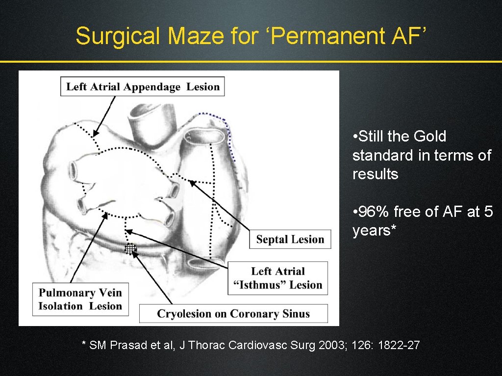 Surgical Maze for ‘Permanent AF’ • Still the Gold standard in terms of results
