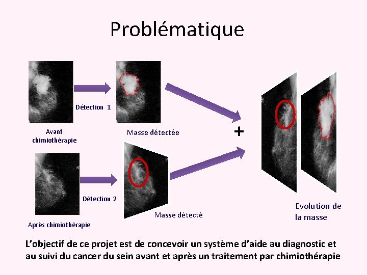 Problématique Détection 1 Masse détectée Avant chimiothérapie Détection 2 Masse détecté Après chimiothérapie +
