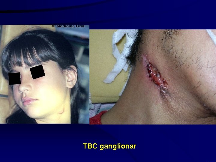 TBC ganglionar 