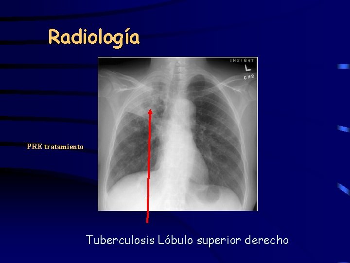 Radiología PRE tratamiento Tuberculosis Lóbulo superior derecho 