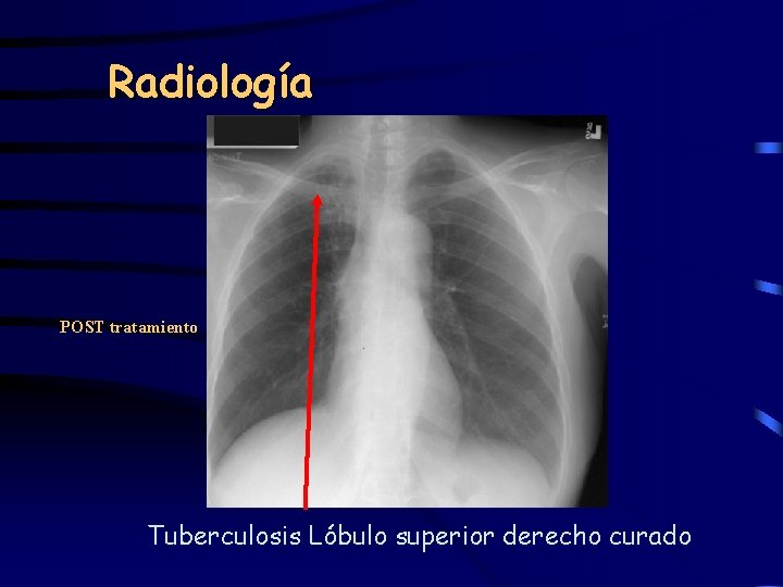 Radiología POST tratamiento Tuberculosis Lóbulo superior derecho curado 