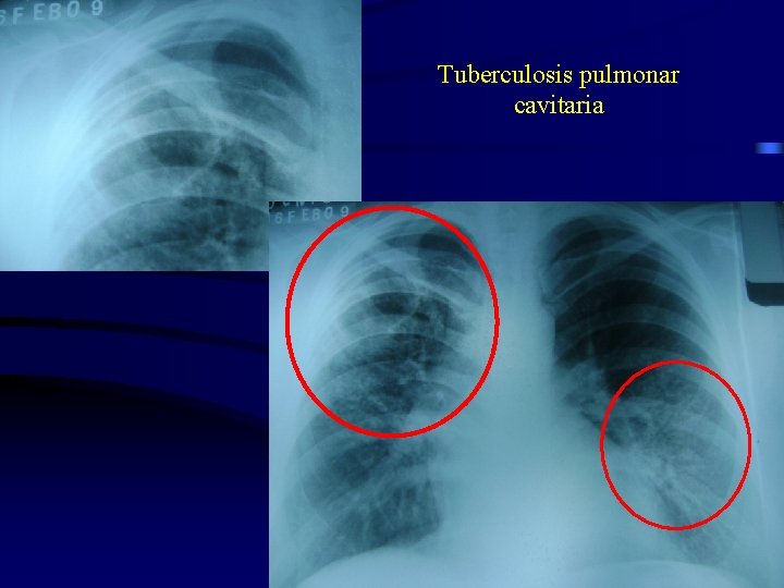 Tuberculosis pulmonar cavitaria 