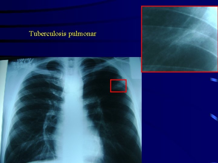 Tuberculosis pulmonar 