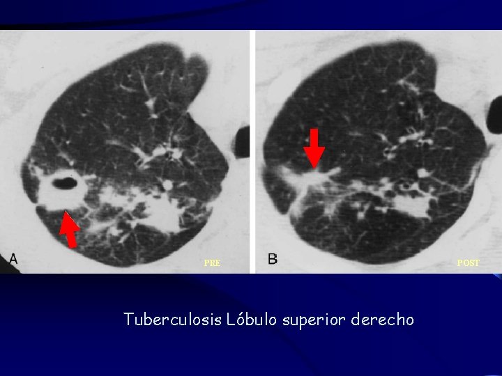 PRE Tuberculosis Lóbulo superior derecho POST 