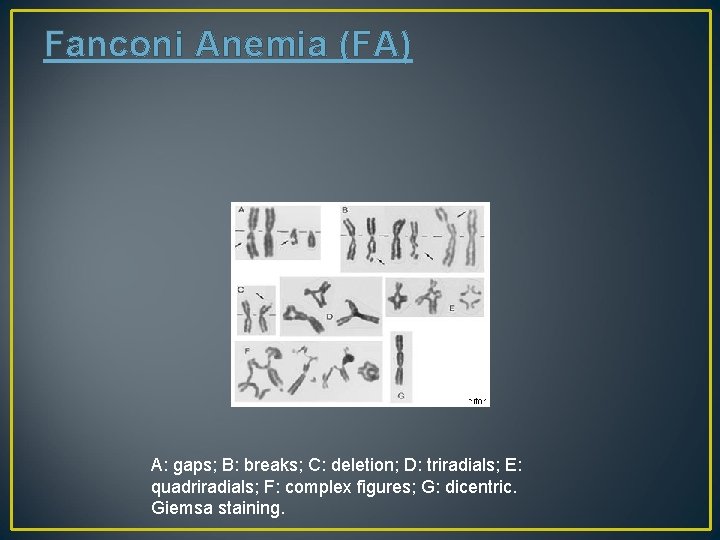 Fanconi Anemia (FA) A: gaps; B: breaks; C: deletion; D: triradials; E: quadriradials; F: