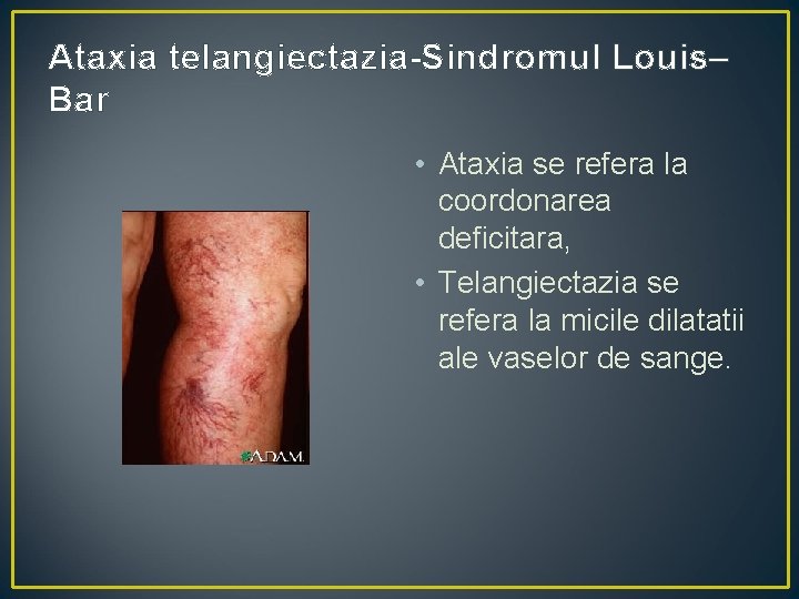 Ataxia telangiectazia-Sindromul Louis– Bar • Ataxia se refera la coordonarea deficitara, • Telangiectazia se