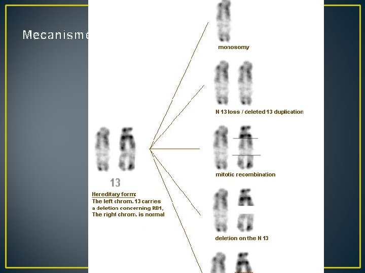 Mecanisme ale heterozigozitatii in retinoblastom 