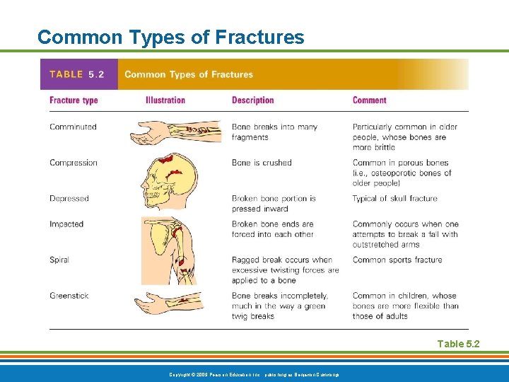 Common Types of Fractures Table 5. 2 Copyright © 2009 Pearson Education, Inc. ,