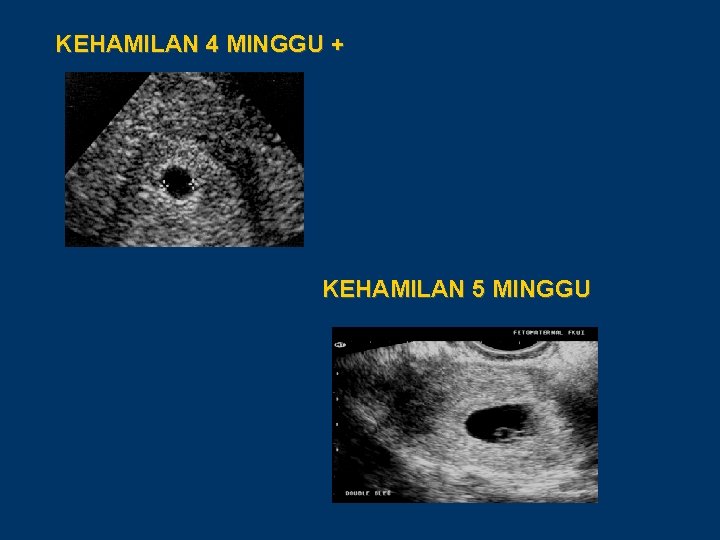 KEHAMILAN 4 MINGGU + KEHAMILAN 5 MINGGU 