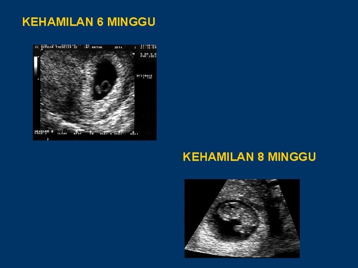 KEHAMILAN 6 MINGGU KEHAMILAN 8 MINGGU 