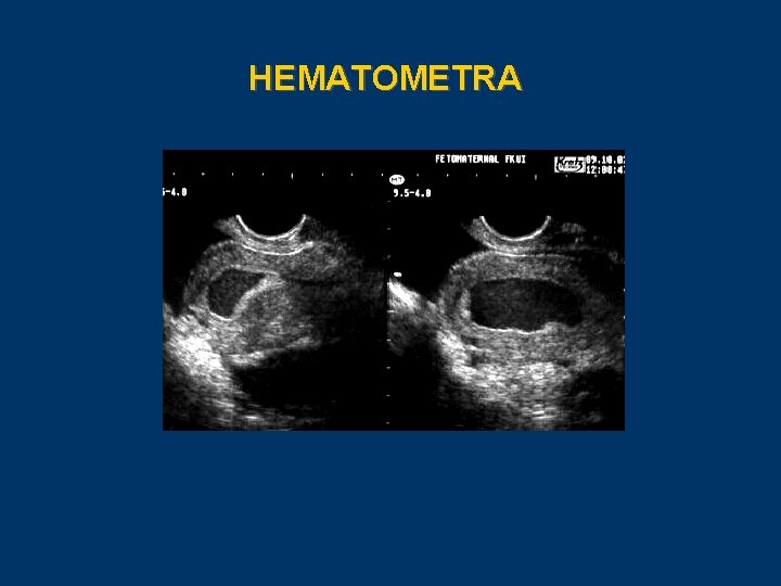 HEMATOMETRA 