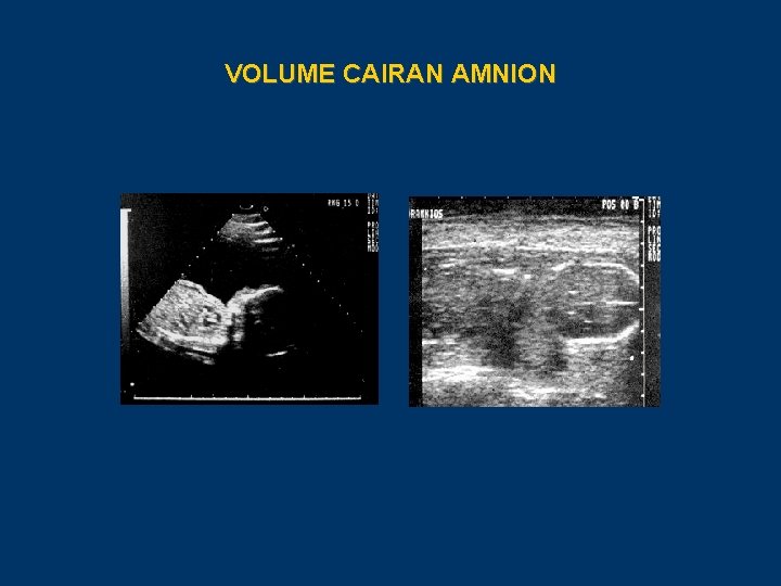 VOLUME CAIRAN AMNION 