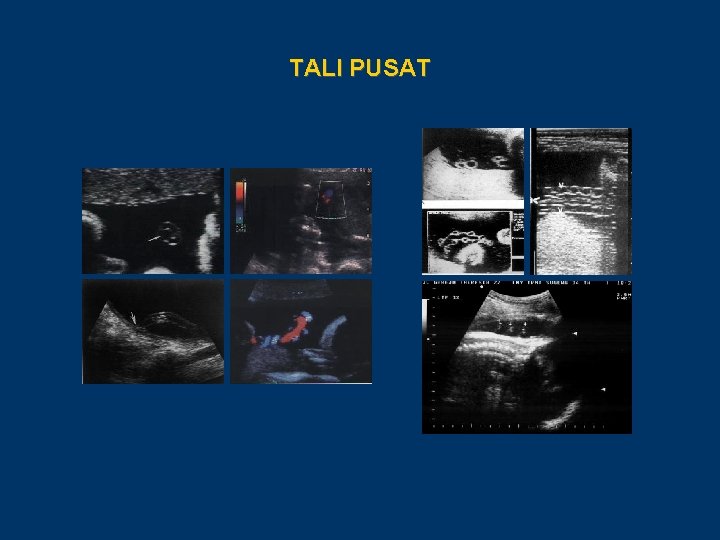 TALI PUSAT 