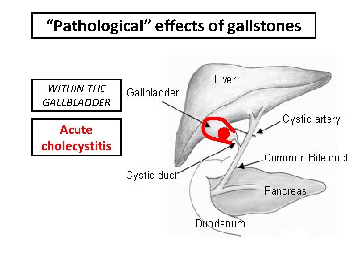 “Pathological” effects of gallstones WITHIN THE GALLBLADDER Acute cholecystitis 