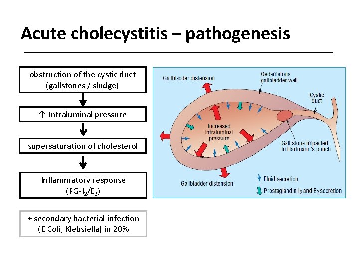 Acute cholecystitis – pathogenesis obstruction of the cystic duct (gallstones / sludge) ↑ Intraluminal
