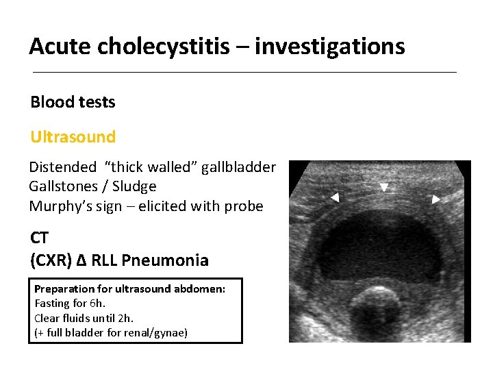 Acute cholecystitis – investigations Blood tests Ultrasound Distended “thick walled” gallbladder Gallstones / Sludge