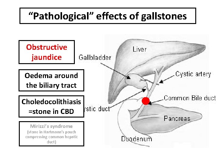 “Pathological” effects of gallstones Obstructive jaundice Oedema around the biliary tract Choledocolithiasis =stone in