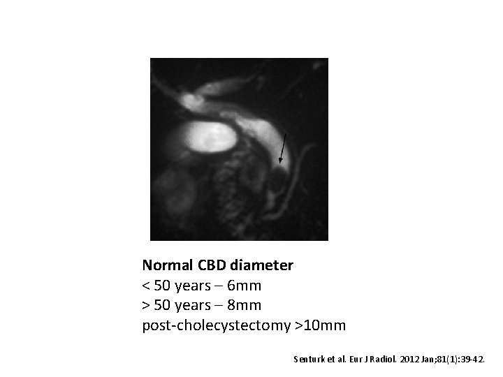 Normal CBD diameter < 50 years – 6 mm > 50 years – 8