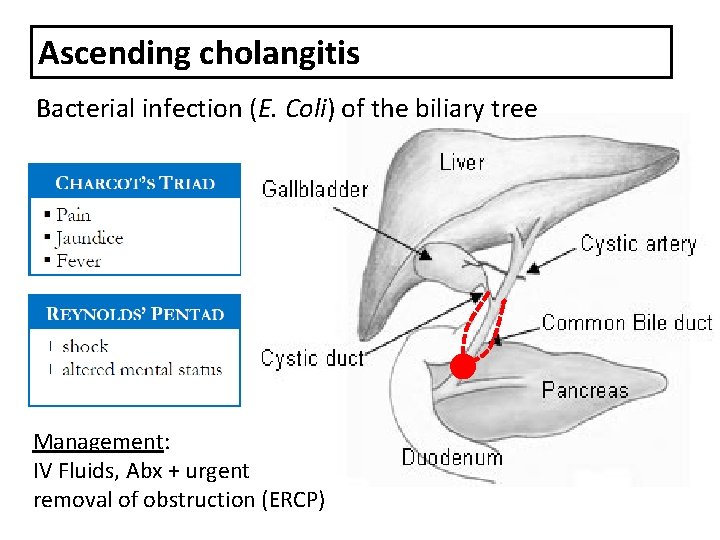 Ascending cholangitis Bacterial infection (E. Coli) of the biliary tree Management: IV Fluids, Abx