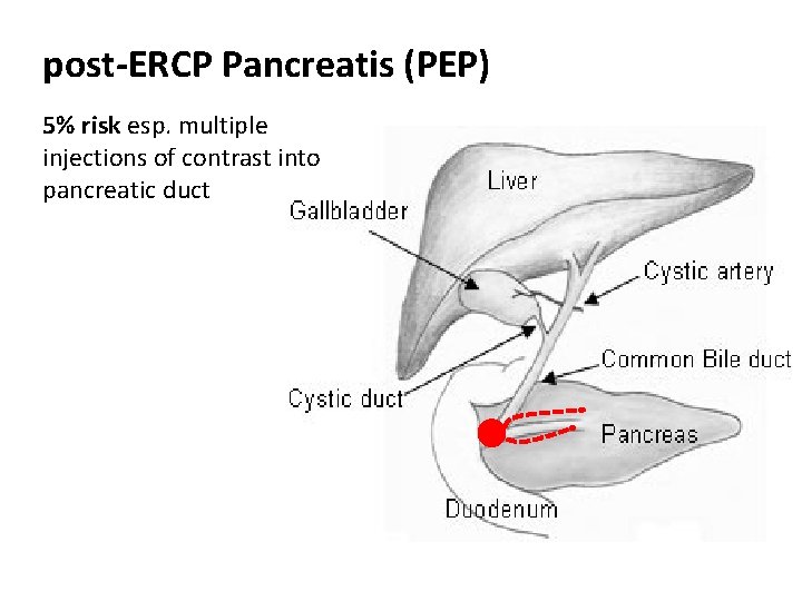 post-ERCP Pancreatis (PEP) 5% risk esp. multiple injections of contrast into pancreatic duct 
