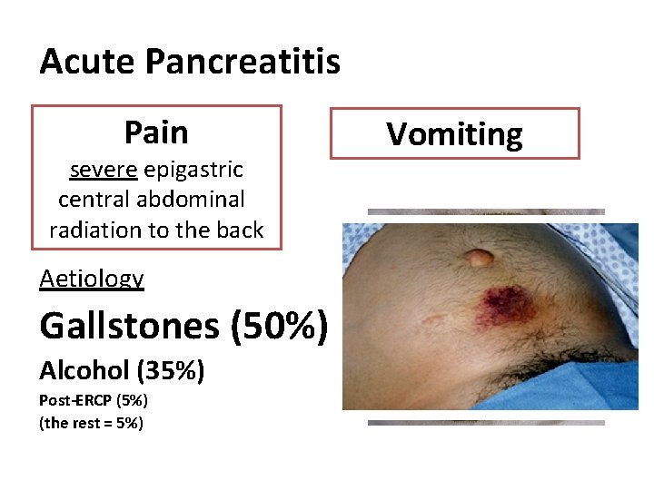 Acute Pancreatitis Pain severe epigastric central abdominal radiation to the back Aetiology Gallstones (50%)
