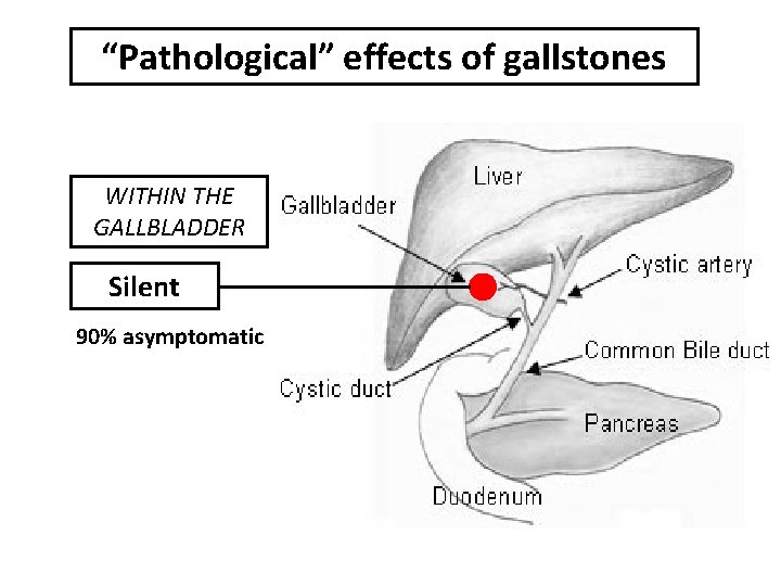 “Pathological” effects of gallstones WITHIN THE GALLBLADDER Silent 90% asymptomatic 