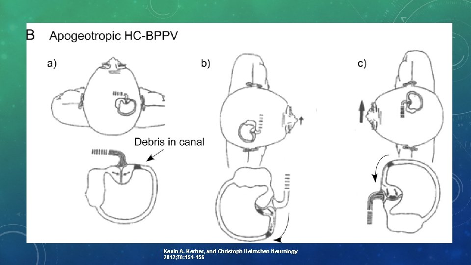 Kevin A. Kerber, and Christoph Helmchen Neurology 2012; 78: 154 -156 