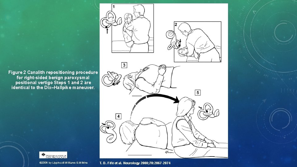 Figure 2 Canalith repositioning procedure for right-sided benign paroxysmal positional vertigo Steps 1 and