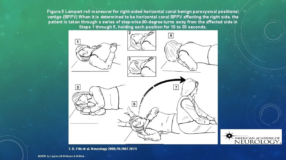 Figure 5 Lempert roll maneuver for right-sided horizontal canal benign paroxysmal positional vertigo (BPPV)
