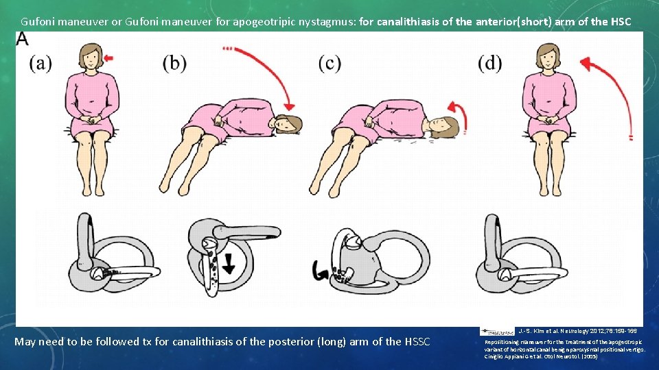 Gufoni maneuver or Gufoni maneuver for apogeotripic nystagmus: for canalithiasis of the anterior(short) arm