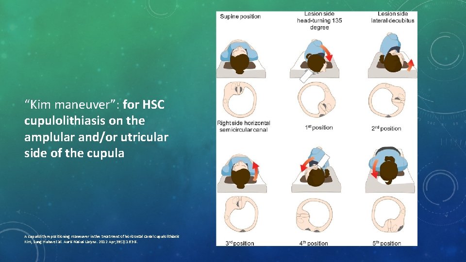 “Kim maneuver”: for HSC cupulolithiasis on the amplular and/or utricular side of the cupula