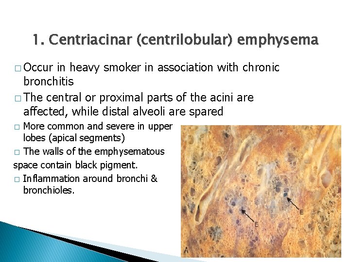 1. Centriacinar (centrilobular) emphysema � Occur in heavy smoker in association with chronic bronchitis