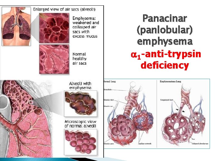 Panacinar (panlobular) emphysema 1 -anti-trypsin deficiency 