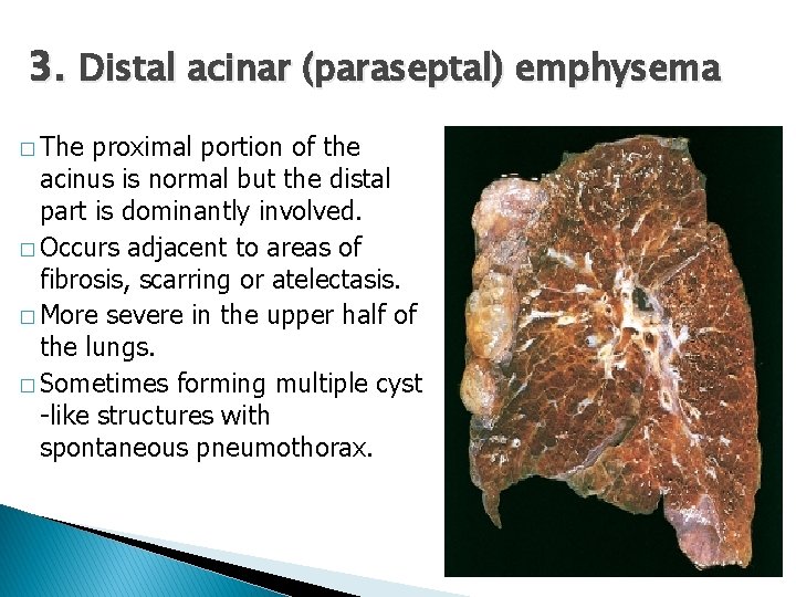 3. Distal acinar (paraseptal) emphysema � The proximal portion of the acinus is normal