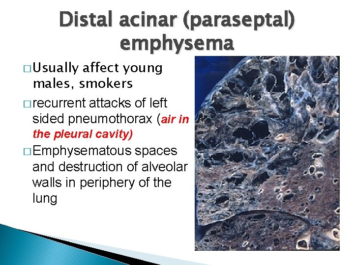 Distal acinar (paraseptal) emphysema � Usually affect young males, smokers � recurrent attacks of