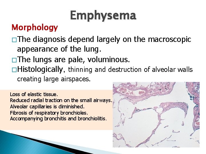 Emphysema Morphology � The diagnosis depend largely on the macroscopic appearance of the lung.