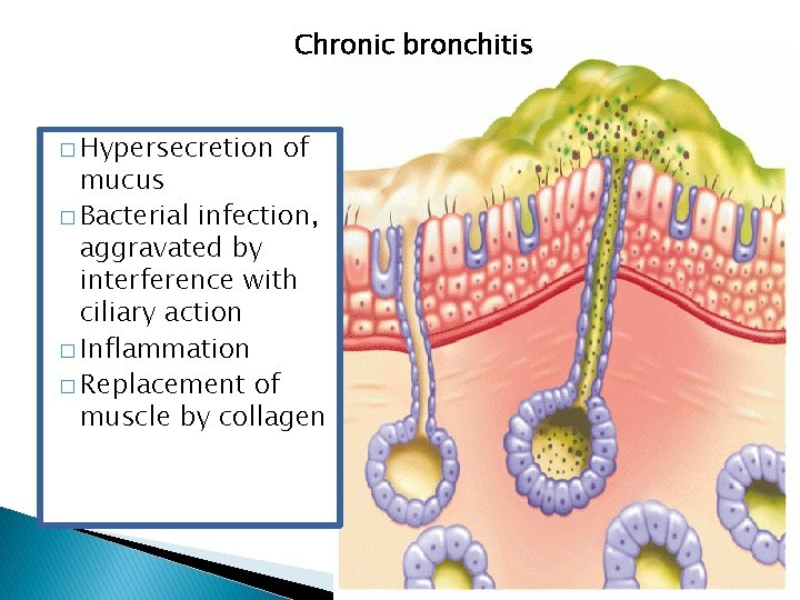 Chronic bronchitis � Hypersecretion of mucus � Bacterial infection, aggravated by interference with ciliary