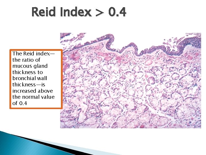 Reid Index > 0. 4 The Reid index— the ratio of mucous gland thickness