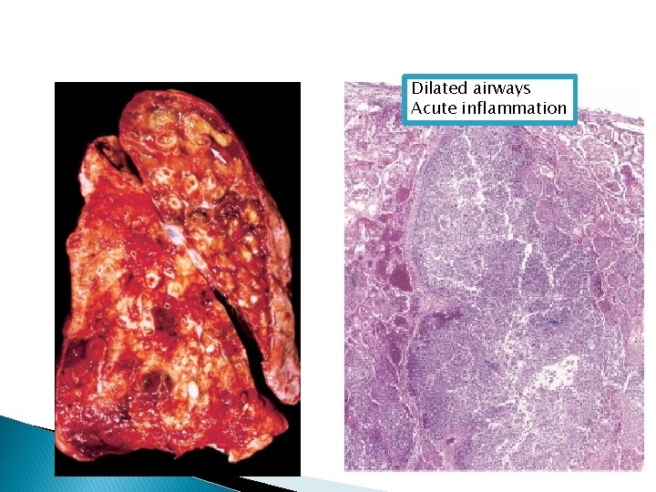 Dilated airways Acute inflammation 