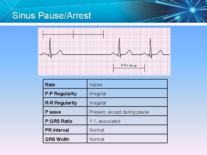 Sinus Pause/Arrest Rate Varies P-P Regularity Irregular R-R Regularity Irregular P wave Present, except