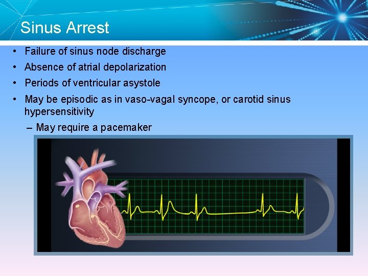 Sinus Arrest • Failure of sinus node discharge • Absence of atrial depolarization •