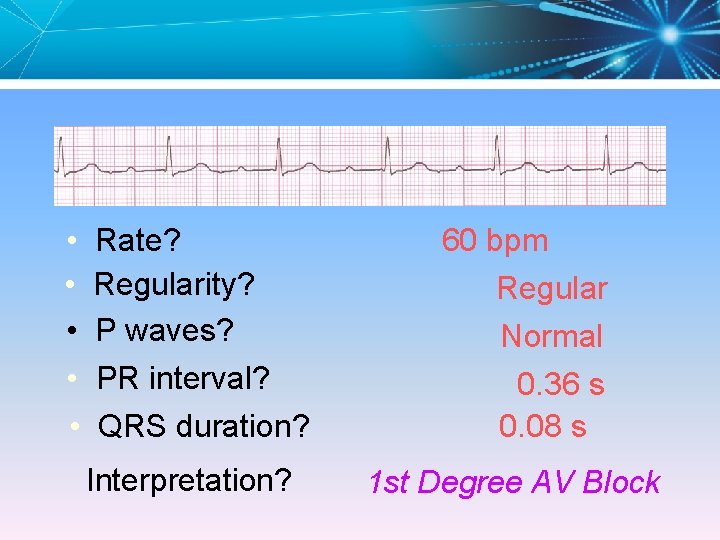  • Rate? • Regularity? • P waves? • PR interval? • QRS duration?